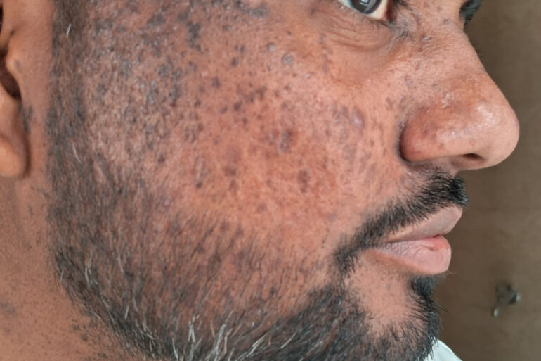 Successful Homeopathic Treatment of 4 Years long Flat Warts through Medicine Transmission