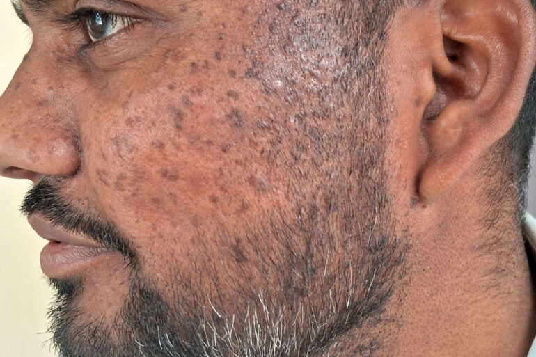 Successful Homeopathic Treatment of 4 Years long Flat Warts through Medicine Transmission
