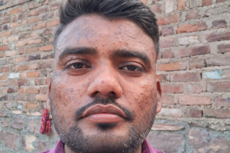 Successful Homeopathic Treatment of 4 Years long Flat Warts through Medicine Transmission