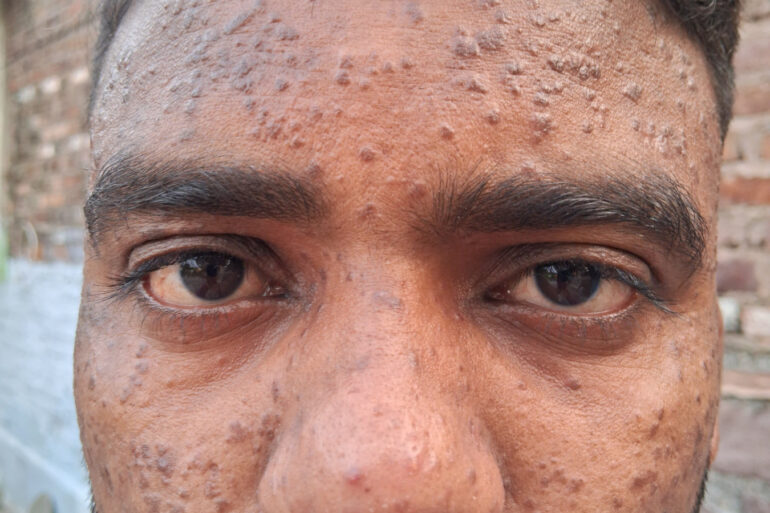 Successful Homeopathic Treatment of 4 Years long Flat Warts through Medicine Transmission