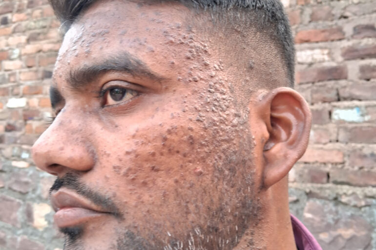Successful Homeopathic Treatment of 4 Years long Flat Warts through Medicine Transmission