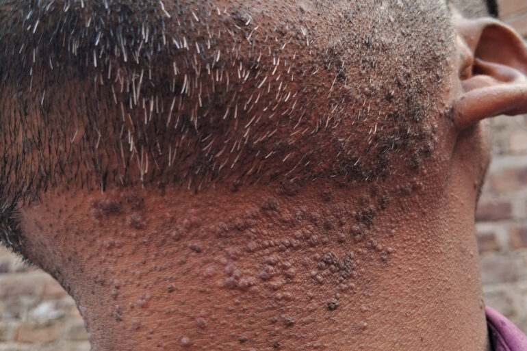 Successful Homeopathic Treatment of 4 Years long Flat Warts through Medicine Transmission