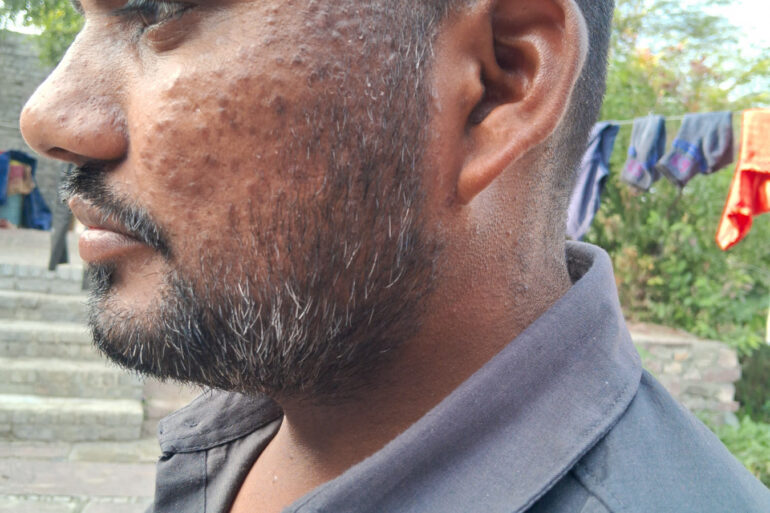 Successful Homeopathic Treatment of 4 Years long Flat Warts through Medicine Transmission