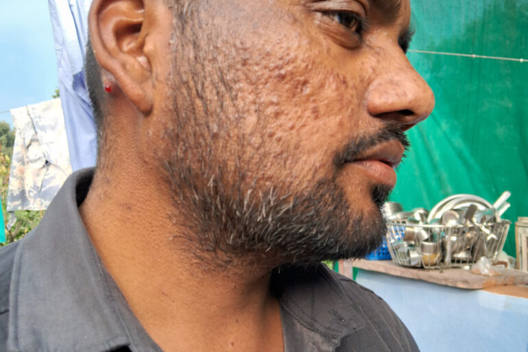Successful Homeopathic Treatment of 4 Years long Flat Warts through Medicine Transmission