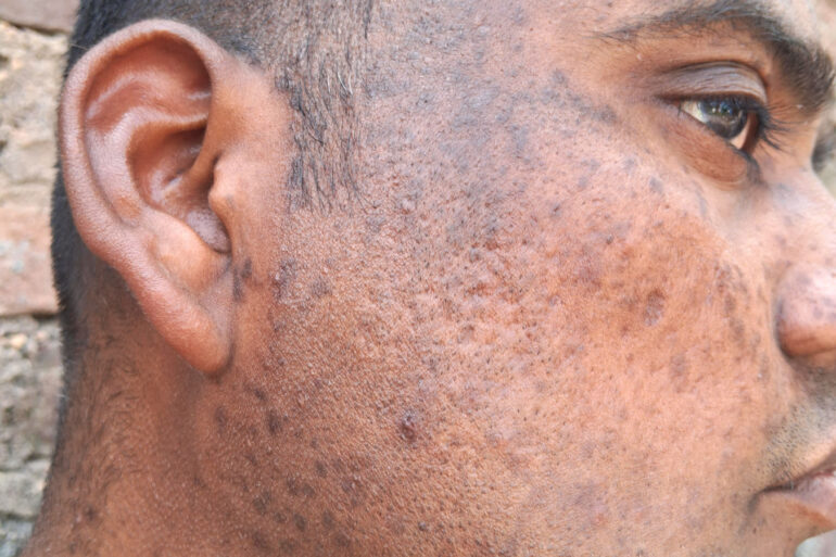 Successful Homeopathic Treatment of 4 Years long Flat Warts through Medicine Transmission