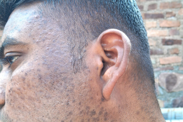 Successful Homeopathic Treatment of 4 Years long Flat Warts through Medicine Transmission