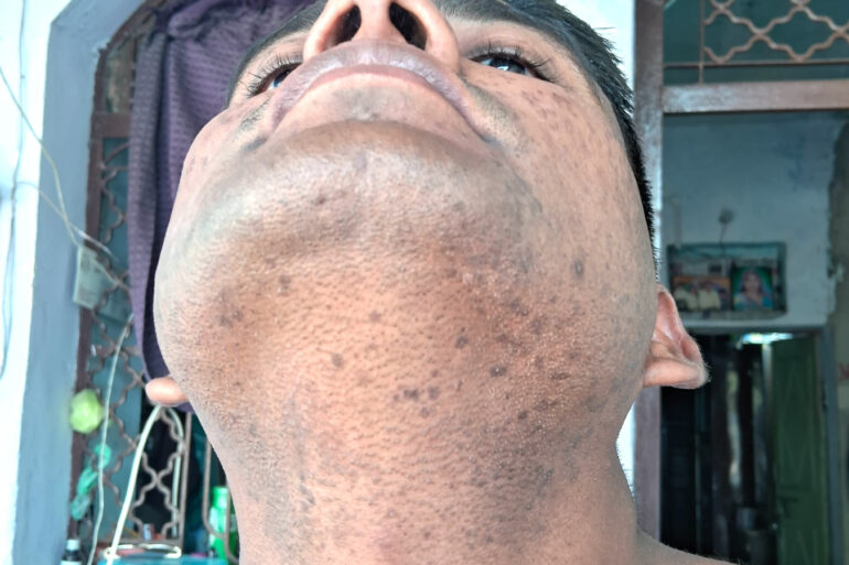 Successful Homeopathic Treatment of 4 Years long Flat Warts through Medicine Transmission