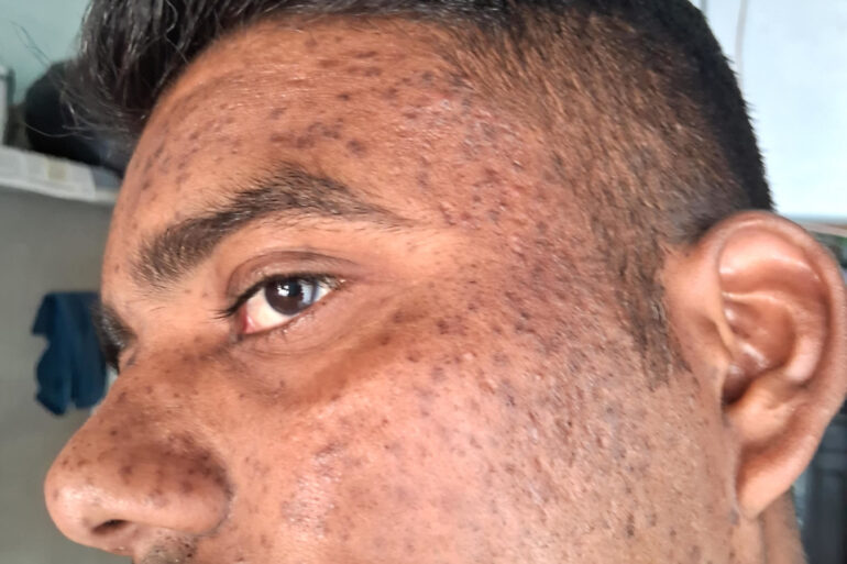 Successful Homeopathic Treatment of 4 Years long Flat Warts through Medicine Transmission