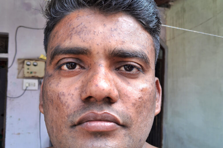 Successful Homeopathic Treatment of 4 Years long Flat Warts through Medicine Transmission
