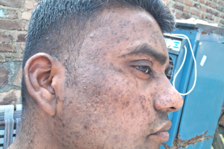 Successful Homeopathic Treatment of 4 Years long Flat Warts through Medicine Transmission