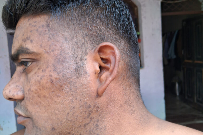 Successful Homeopathic Treatment of 4 Years long Flat Warts through Medicine Transmission
