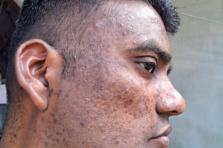 Successful Homeopathic Treatment of 4 Years long Flat Warts through Medicine Transmission