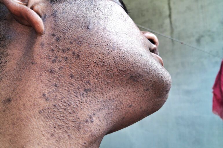Successful Homeopathic Treatment of 4 Years long Flat Warts through Medicine Transmission