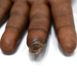 Homeopathy Saved the Limb- A Case of Buerger’s Disease (Thromboangiitis Obliterans – TAO)