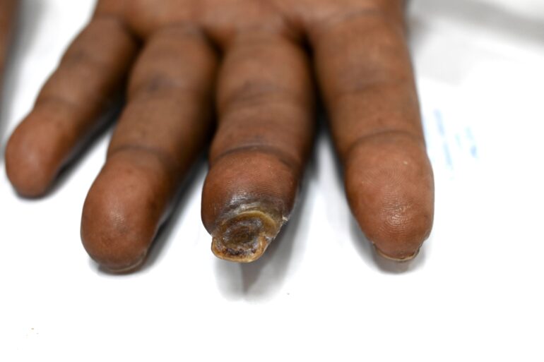 Homeopathy Saved the Limb- A Case of Buerger’s Disease (Thromboangiitis Obliterans – TAO)
