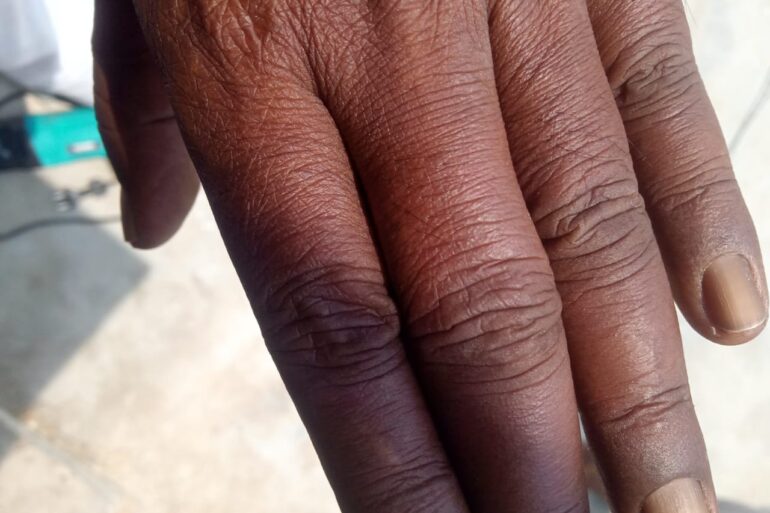 Homeopathy Saved the Limb- A Case of Buerger’s Disease (Thromboangiitis Obliterans – TAO)