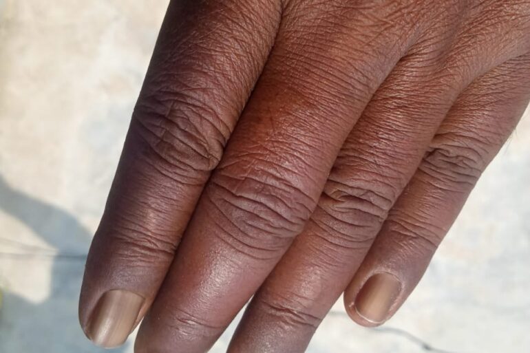 Homeopathy Saved the Limb- A Case of Buerger’s Disease (Thromboangiitis Obliterans – TAO)