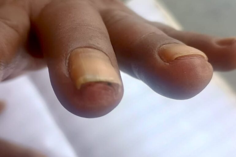 Homeopathy Saved the Limb- A Case of Buerger’s Disease (Thromboangiitis Obliterans – TAO)