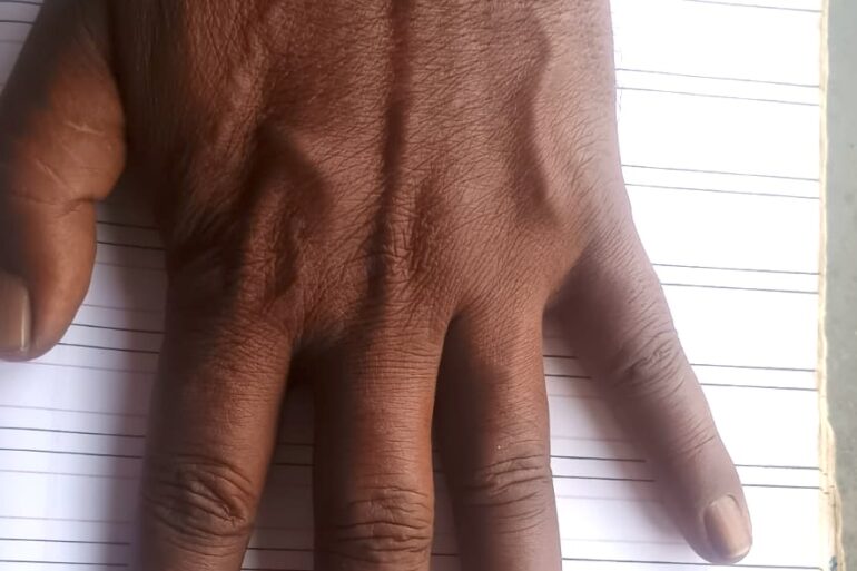Homeopathy Saved the Limb- A Case of Buerger’s Disease (Thromboangiitis Obliterans – TAO)