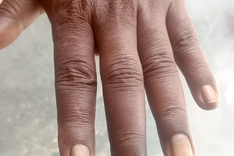 Homeopathy Saved the Limb- A Case of Buerger’s Disease (Thromboangiitis Obliterans – TAO)