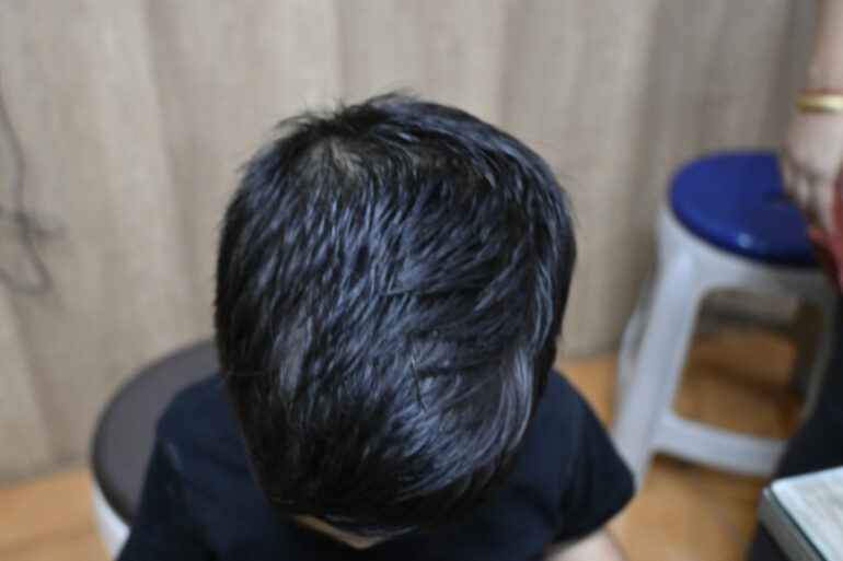 Cure of Scalp and body Psoriasis in child with Classical Homeopathy
