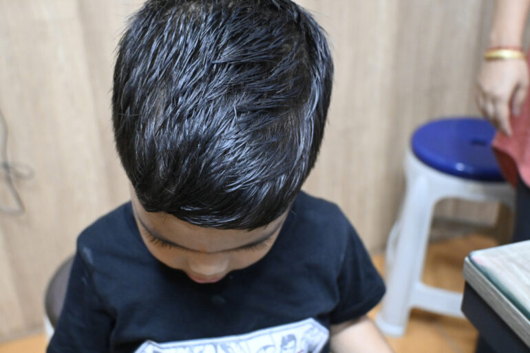 Cure of Scalp and body Psoriasis in child with Classical Homeopathy