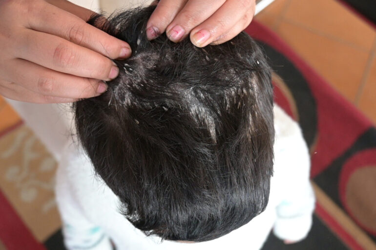 Cure of Scalp and body Psoriasis in child with Classical Homeopathy