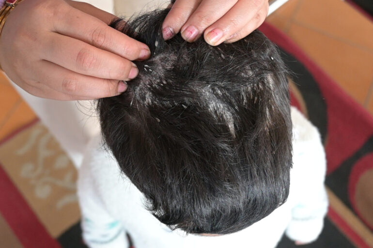Cure of Scalp and body Psoriasis in child with Classical Homeopathy