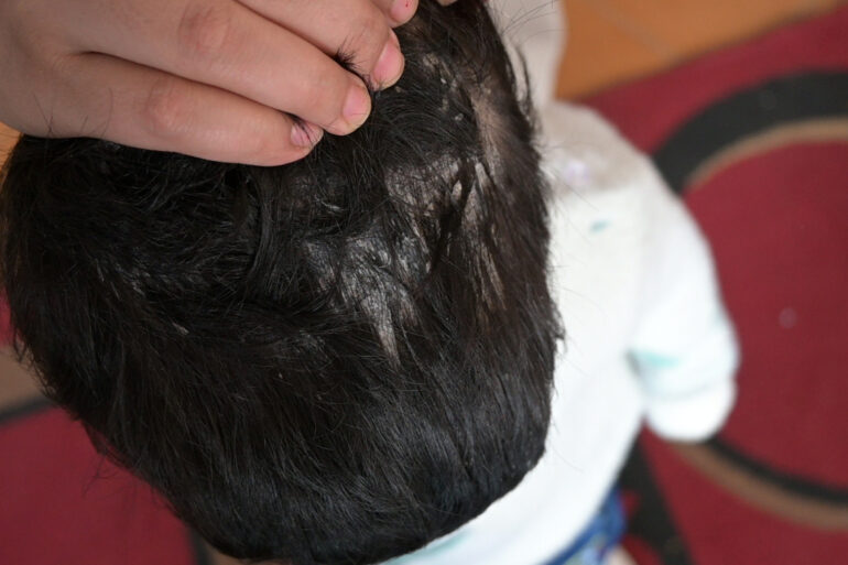 Cure of Scalp and body Psoriasis in child with Classical Homeopathy
