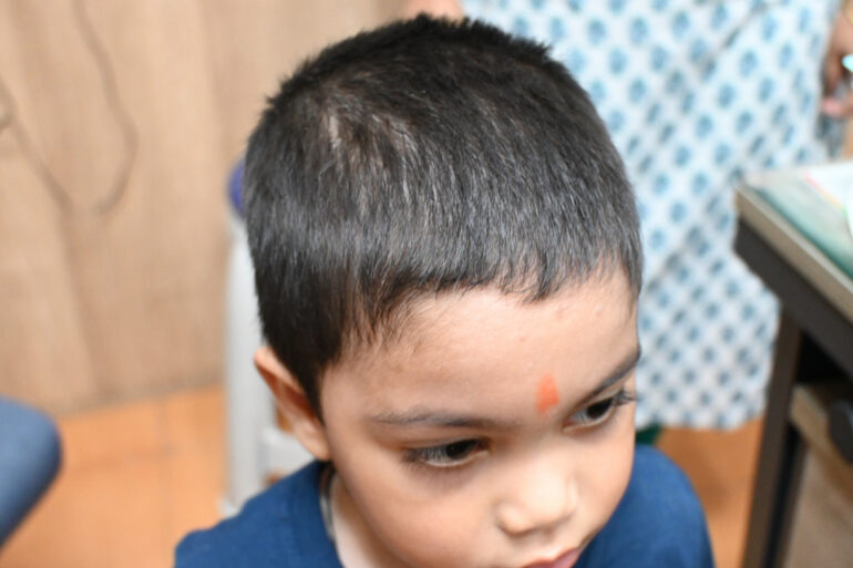 Cure of Scalp and body Psoriasis in child with Classical Homeopathy