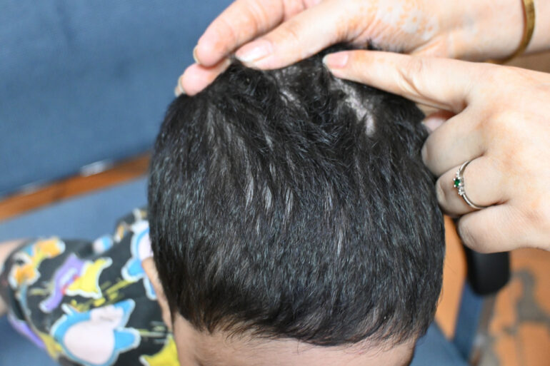 Cure of Scalp and body Psoriasis in child with Classical Homeopathy