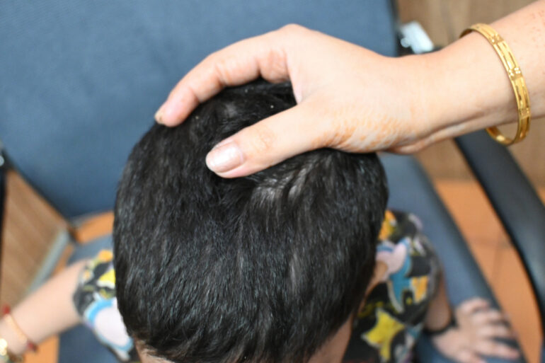 Cure of Scalp and body Psoriasis in child with Classical Homeopathy