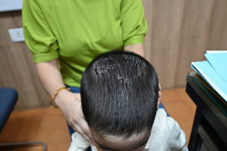 Cure of Scalp and body Psoriasis in child with Classical Homeopathy