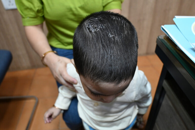 Cure of Scalp and body Psoriasis in child with Classical Homeopathy
