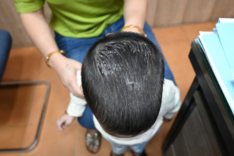Cure of Scalp and body Psoriasis in child with Classical Homeopathy