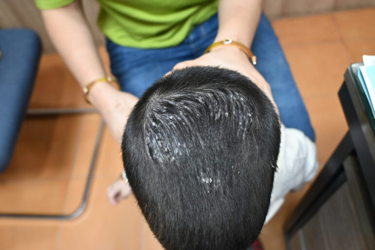 Cure of Scalp and body Psoriasis in child with Classical Homeopathy