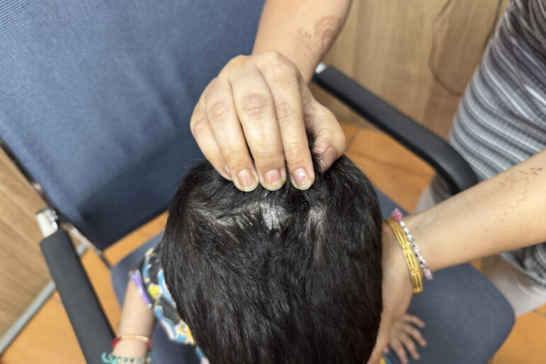 Cure of Scalp and body Psoriasis in child with Classical Homeopathy