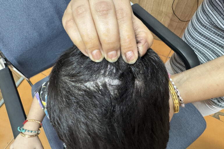 Cure of Scalp and body Psoriasis in child with Classical Homeopathy