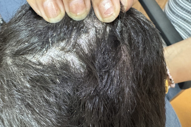 Cure of Scalp and body Psoriasis in child with Classical Homeopathy