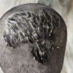 Cure of Scalp and body Psoriasis in child with Classical Homeopathy