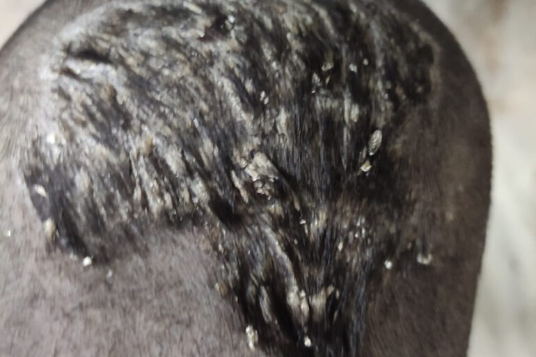 Cure of Scalp and body Psoriasis in child with Classical Homeopathy