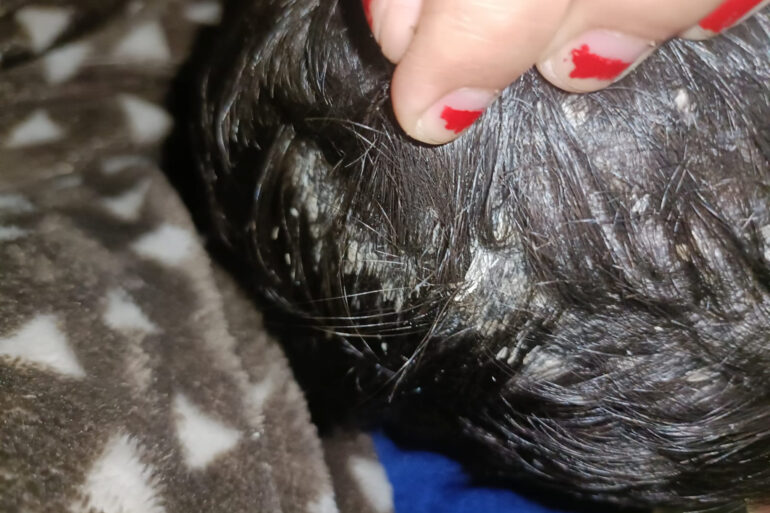 Cure of Scalp and body Psoriasis in child with Classical Homeopathy