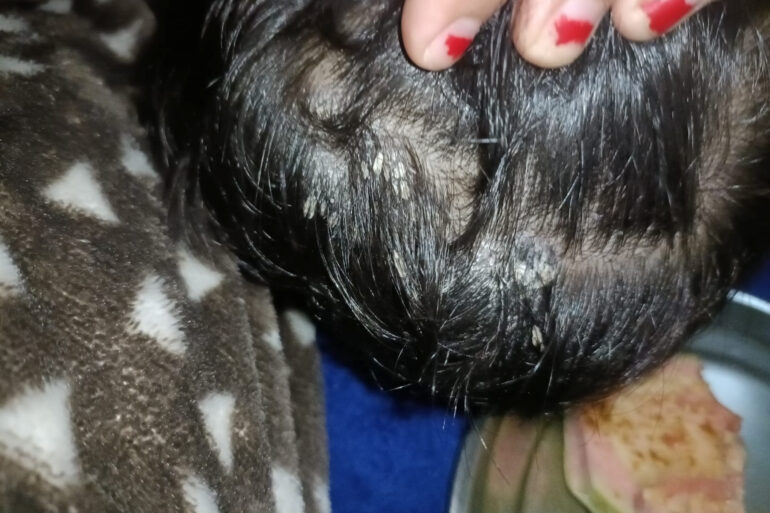 Cure of Scalp and body Psoriasis in child with Classical Homeopathy