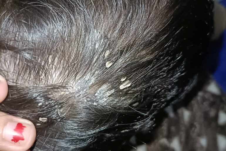 Cure of Scalp and body Psoriasis in child with Classical Homeopathy