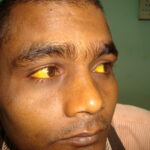Jaundice: High Serum Bilirubin 44.7 totally cured with homeopathy
