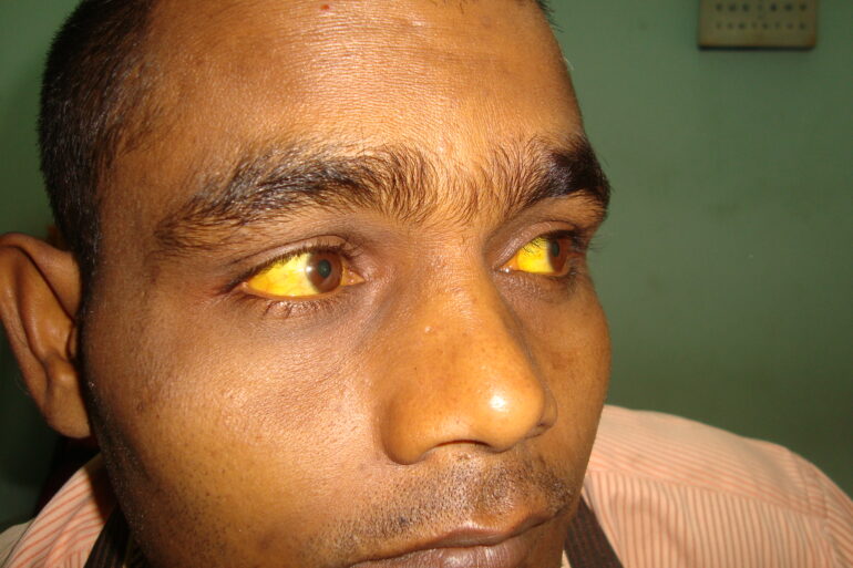 Jaundice: High Serum Bilirubin 44.7 totally cured with homeopathy