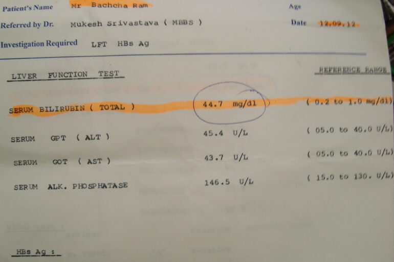 Jaundice: High Serum Bilirubin 44.7 totally cured with homeopathy