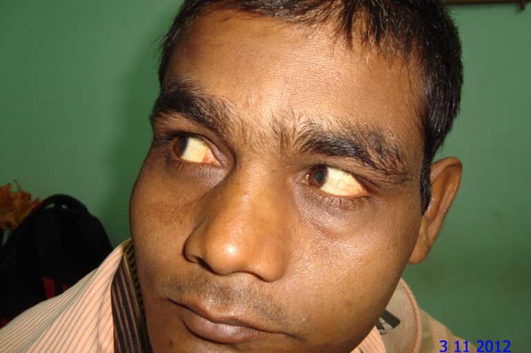 Jaundice: High Serum Bilirubin 44.7 totally cured with homeopathy