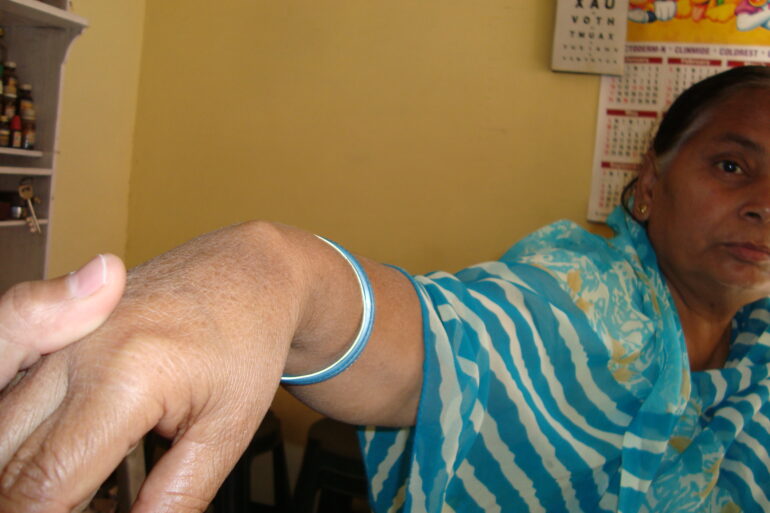 A case of Ganglion in an Old Lady from Balrampur