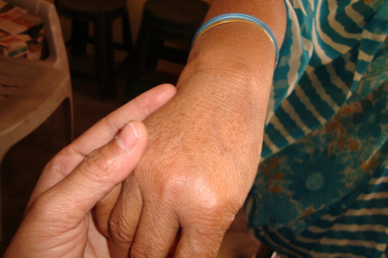 A case of Ganglion in an Old Lady from Balrampur